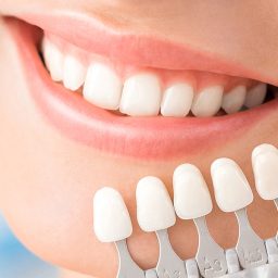 Can Dental Veneers Stain Over Time?