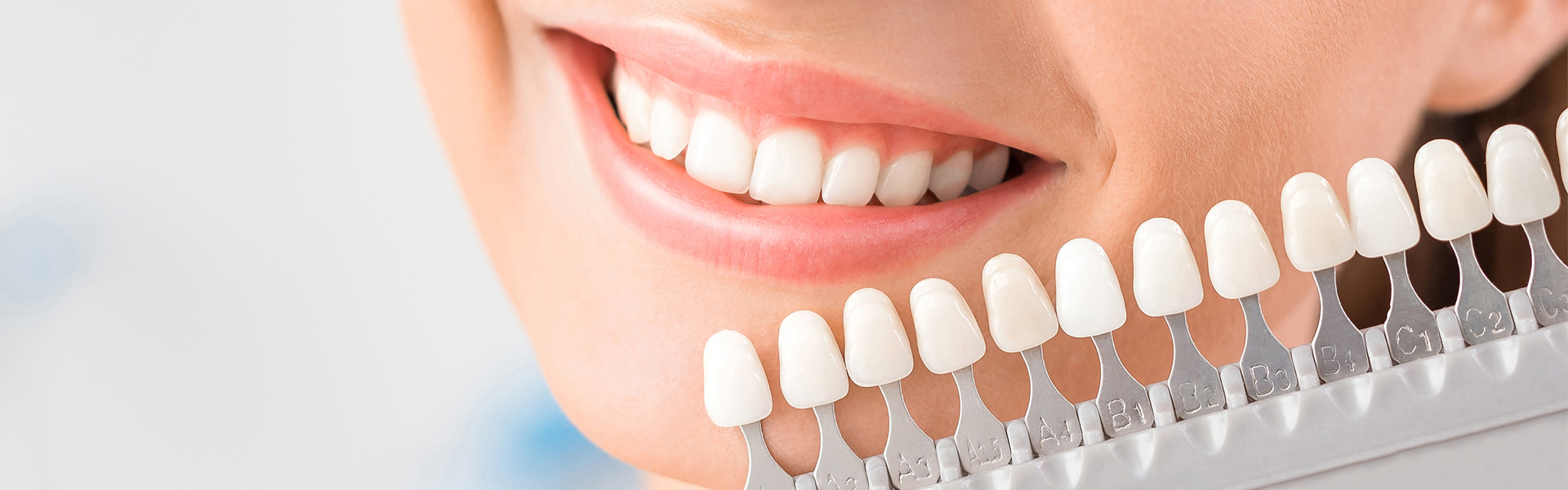 Can Dental Veneers Stain Over Time?