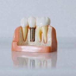 How Same-Day Dental Implants Work: Procedure Explained